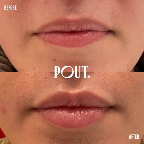 Lip+injections+before+and+after+pics+poutx+toronto