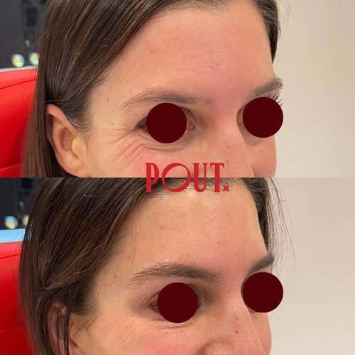 Natural+Eye+Wrinkle+Reduction+with+Botox+at+Poutx+Injections+Toronto