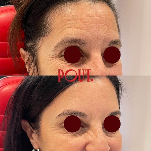 Best+Botox+Clinic+for+Crow's+Feet+and+Eye+Wrinkles+in+Toronto.jpg