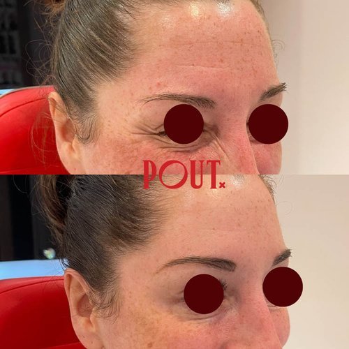 Poutx+Botox+Before+and+After+Results+for+Crow's+Feet+in+Toronto