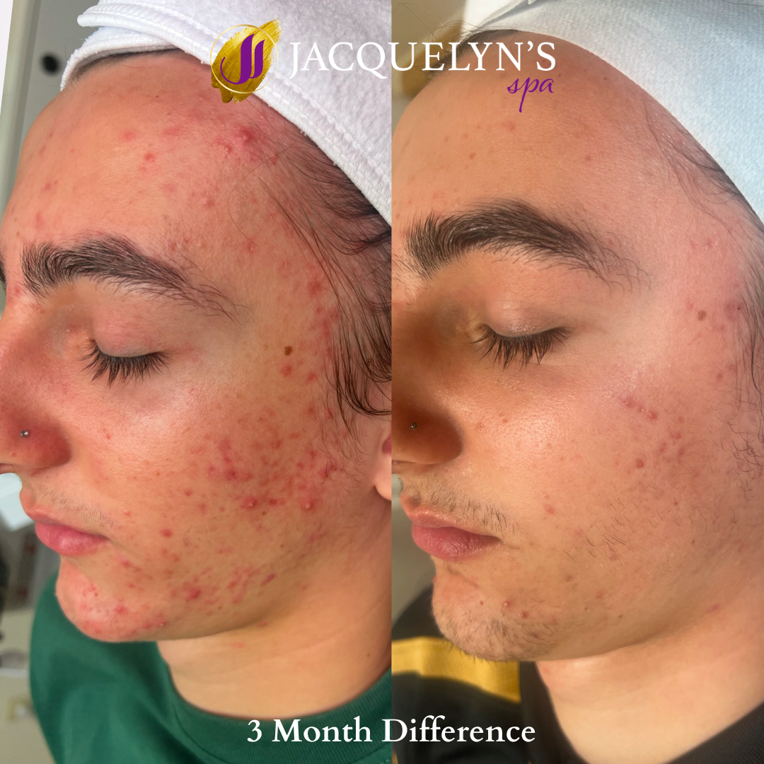 Copy of Acne Before .png (1).PNG