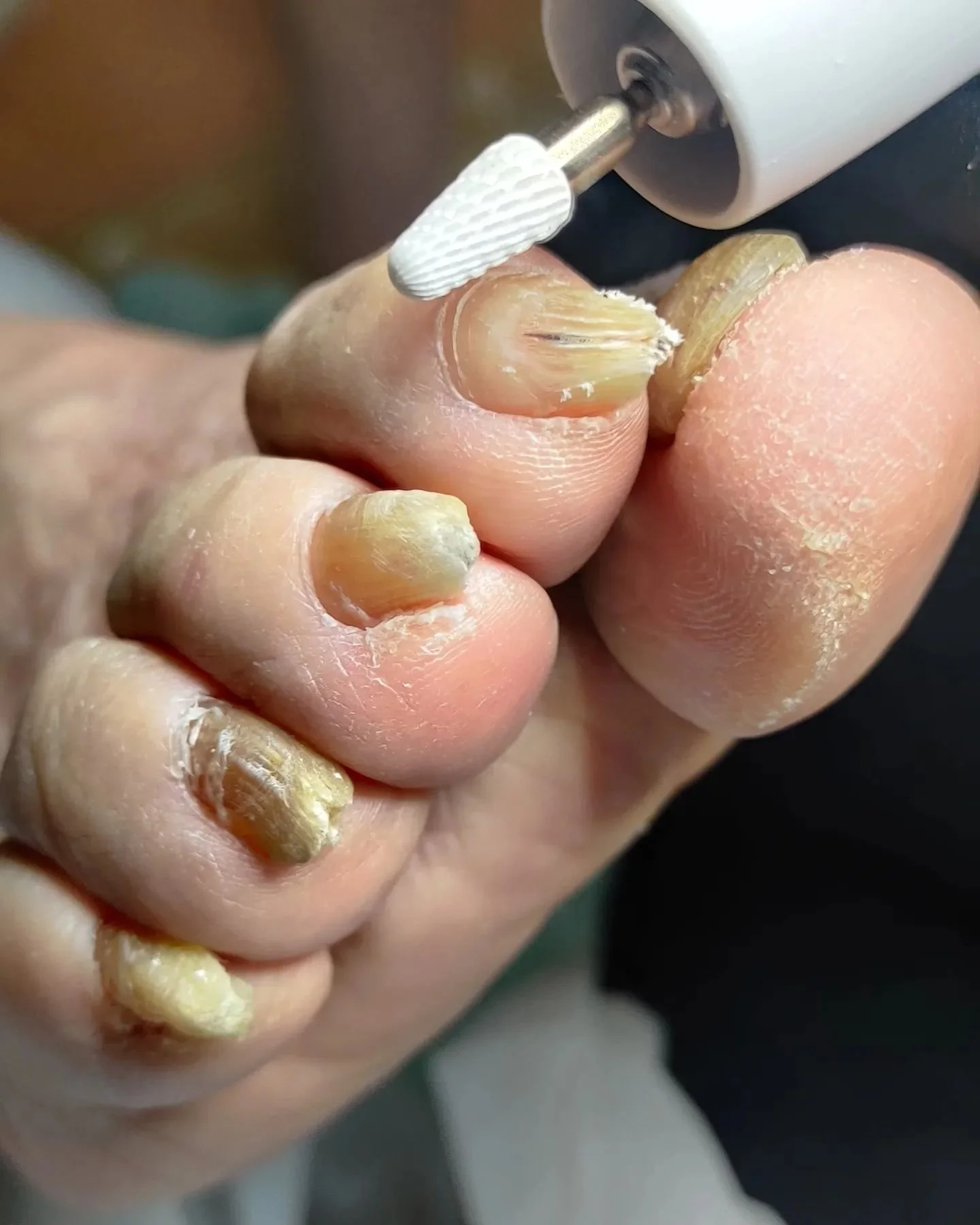 Kynsimuutokset, kynnen paksuuntuminen, kynsisieni