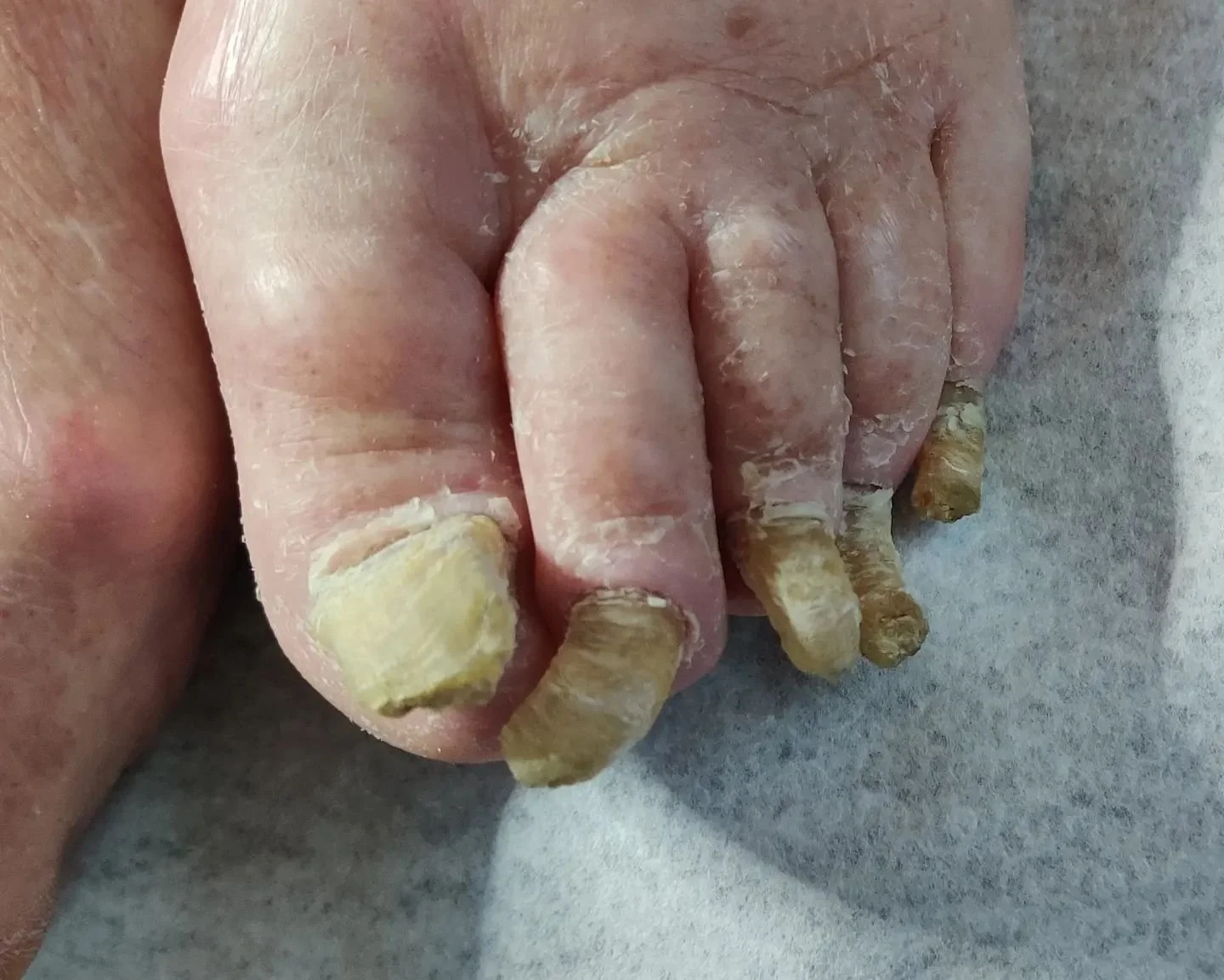 Kynsimuutokset, kotikäynnit