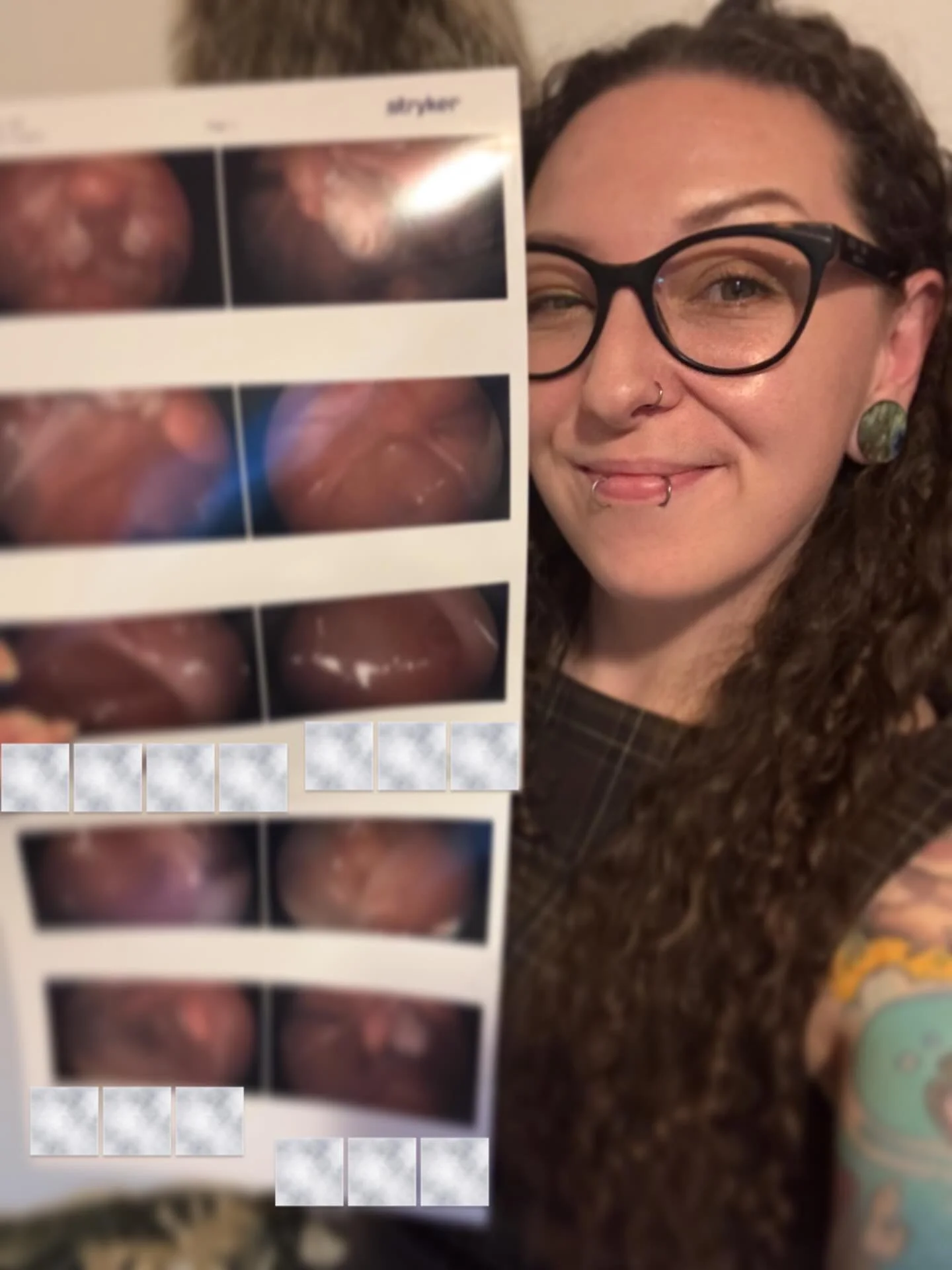 Not so Breaking News: After 15 Years of seeking care, Western medical finally confirms what woman knew about her body all along! 🫠

This is #endometriosis . 

Living (and also not living) through years of medical gaslighting. 

Aura migraines so bad