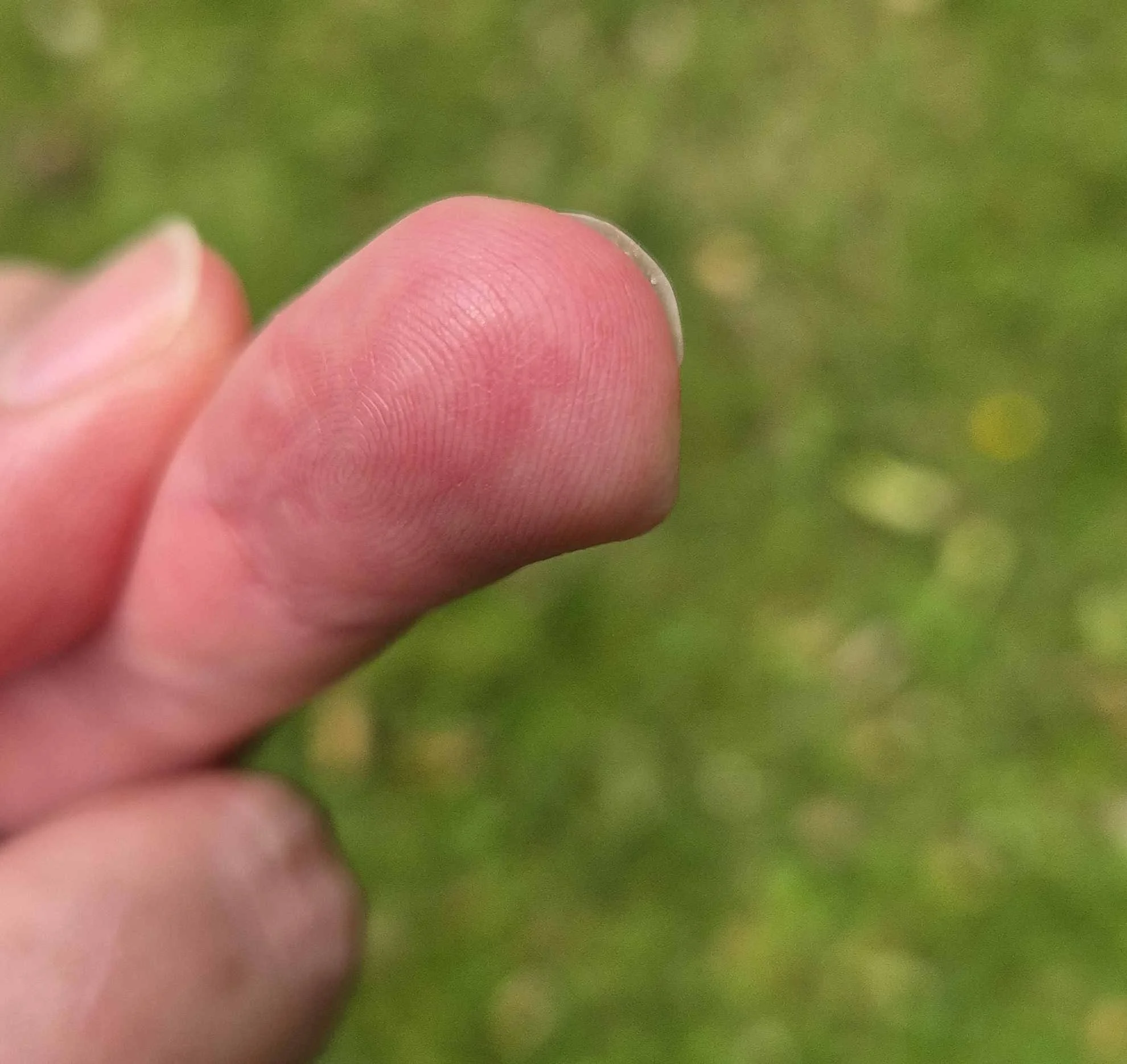 7 months after stopping skin picking