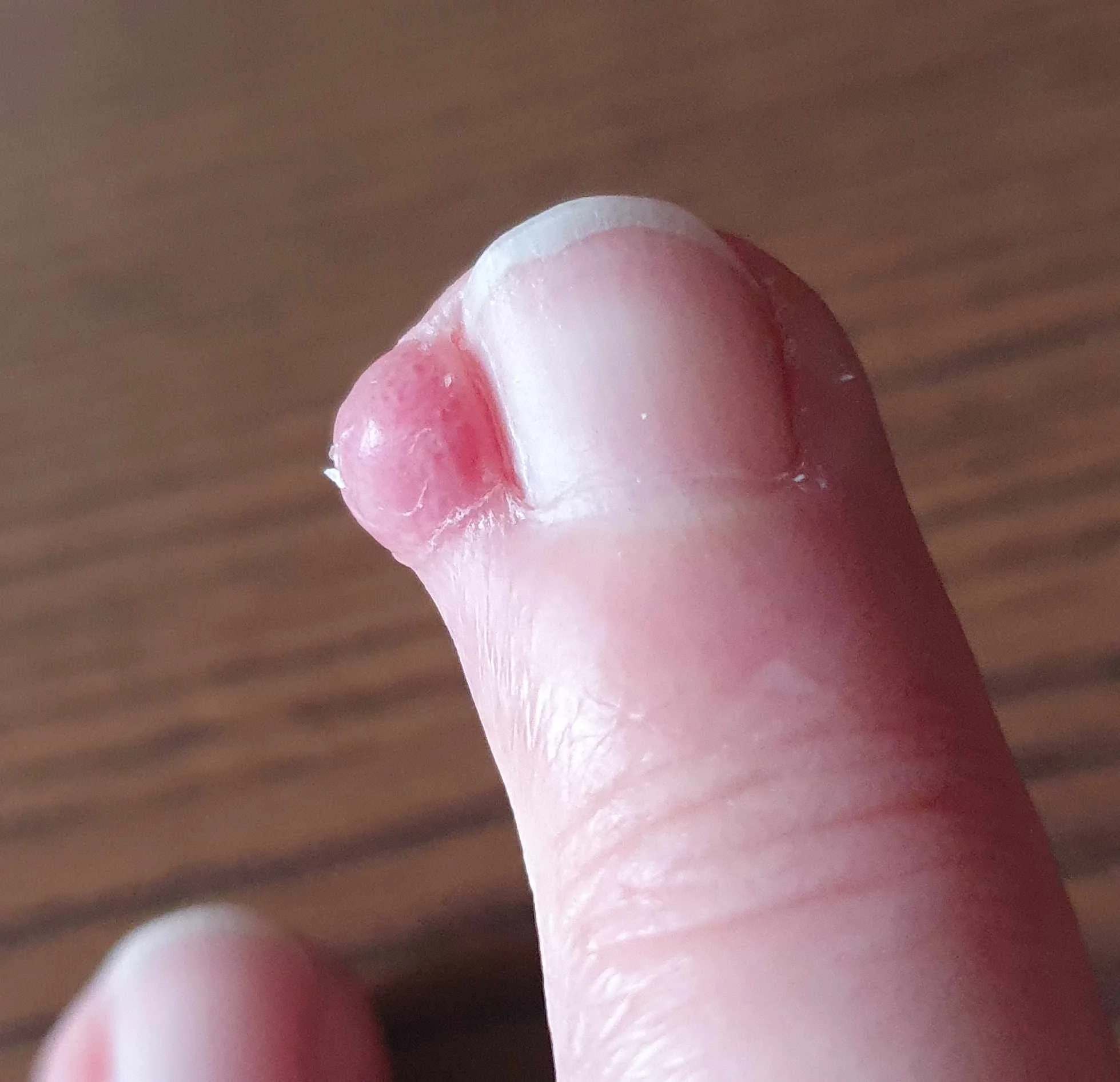 4 months after stopping skin picking