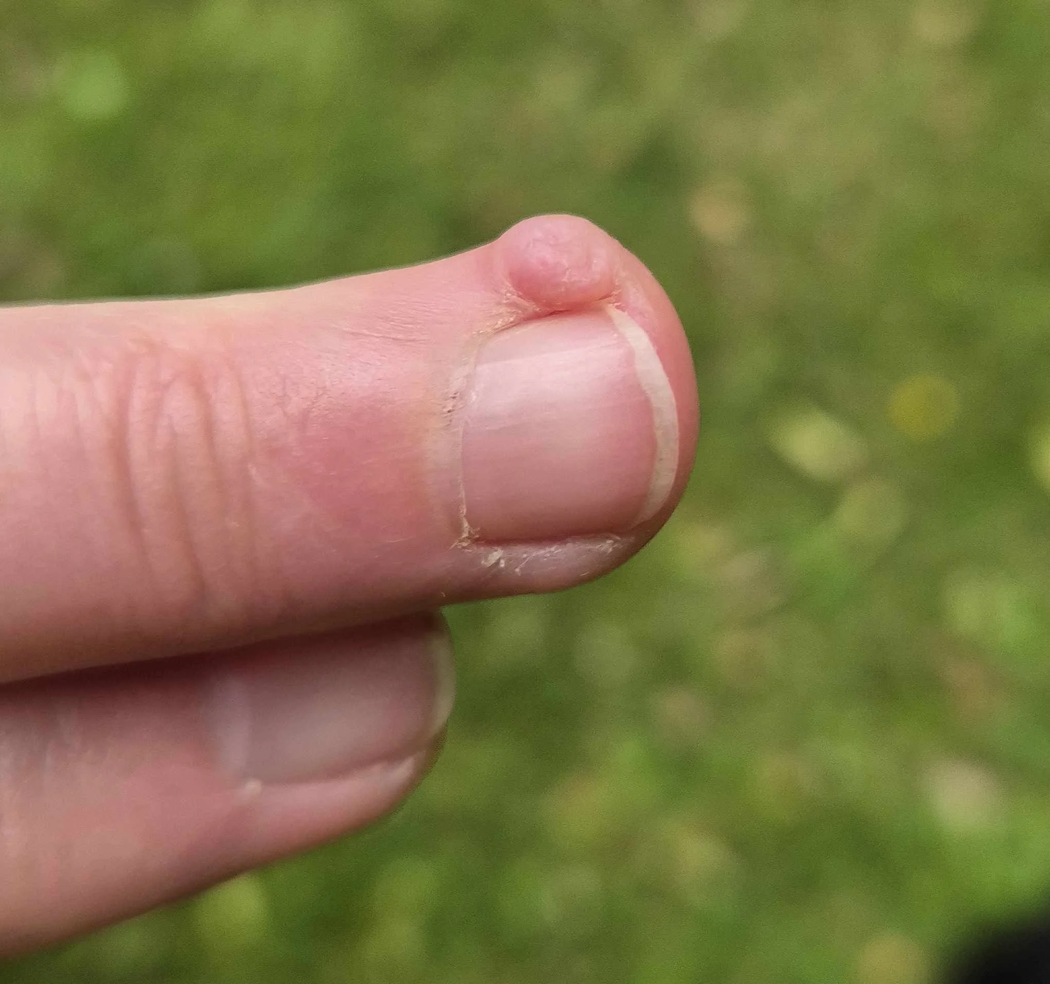 7 months after stopping skin picking