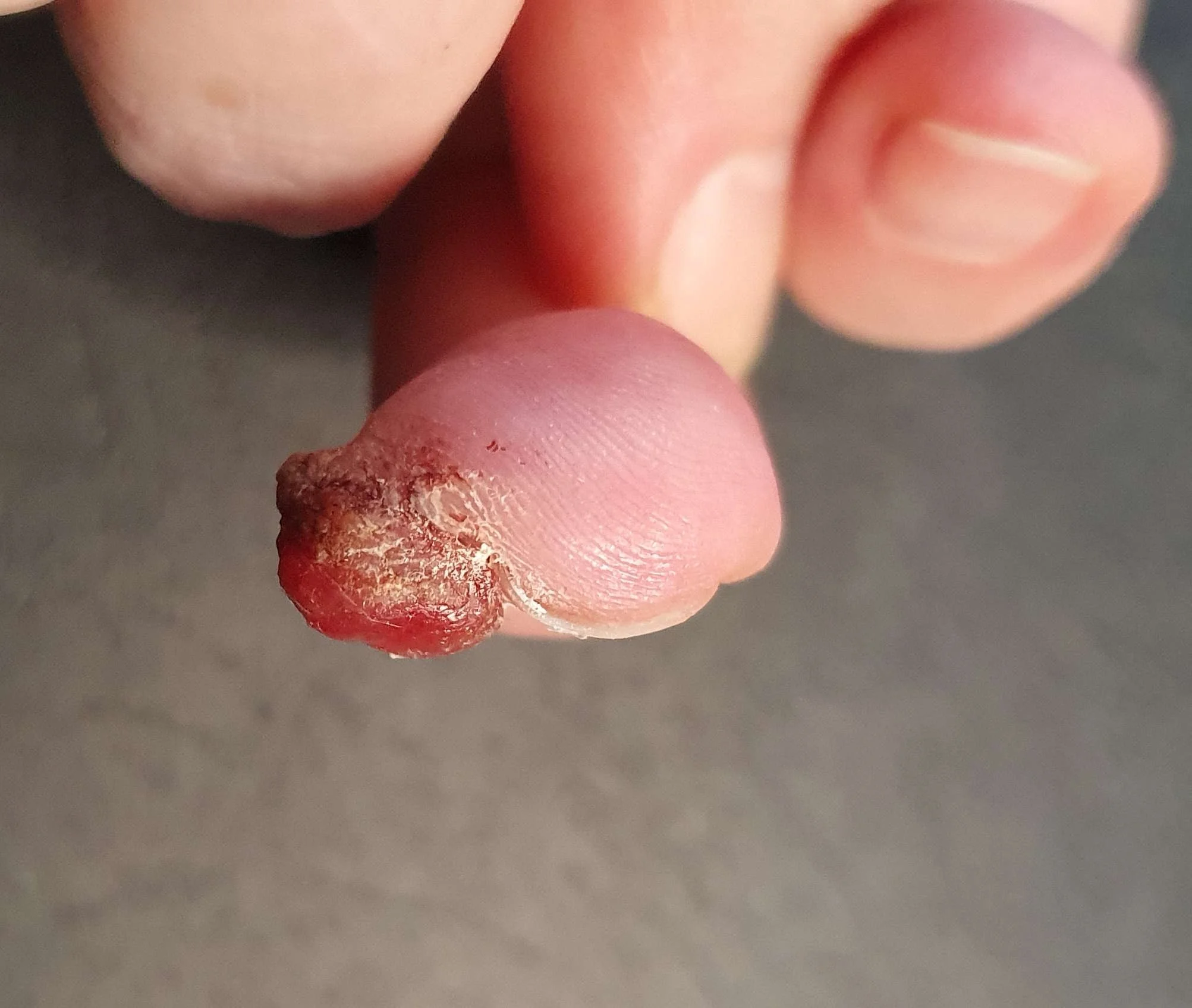 After a month skin picking