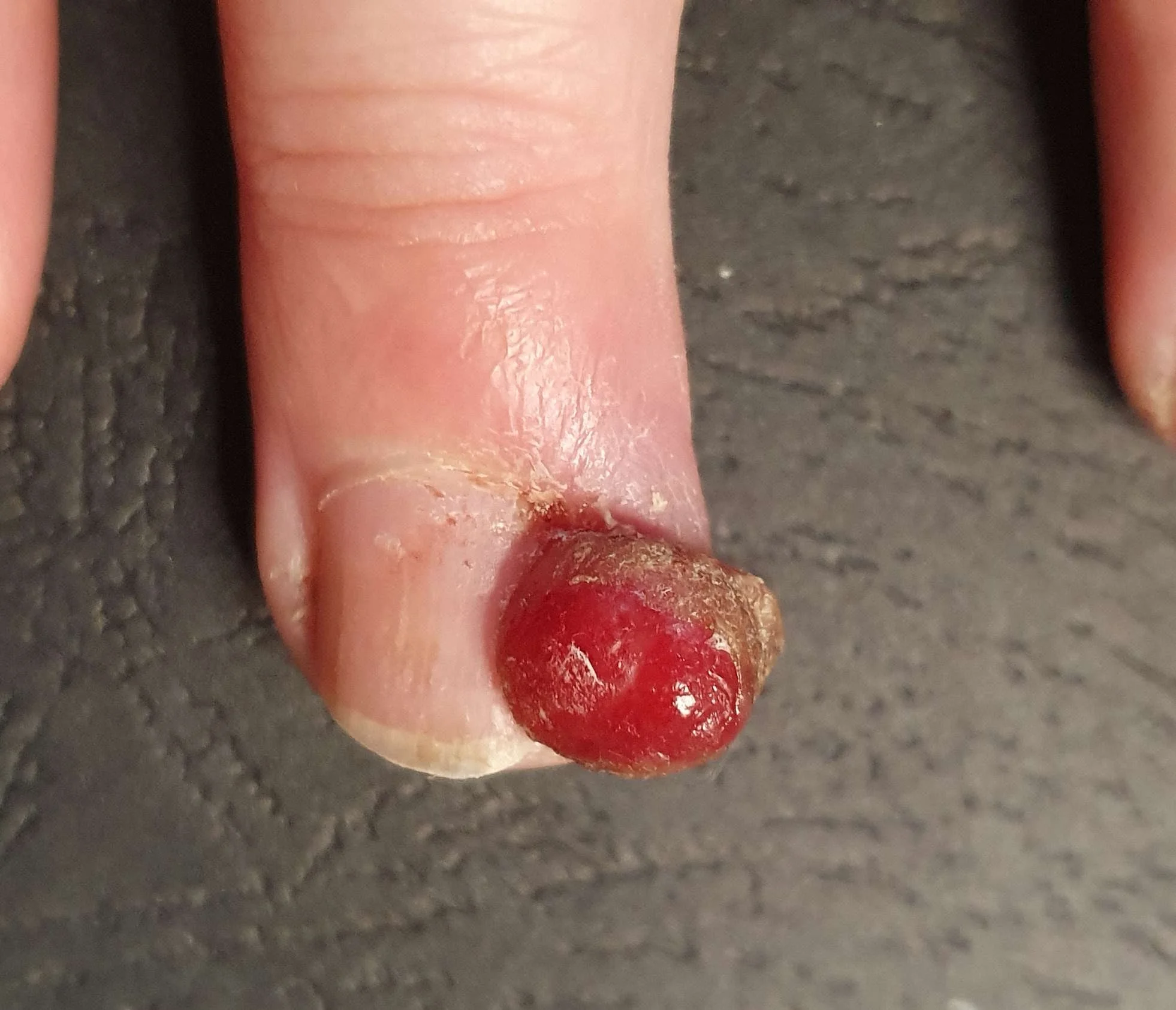 After a month skin picking