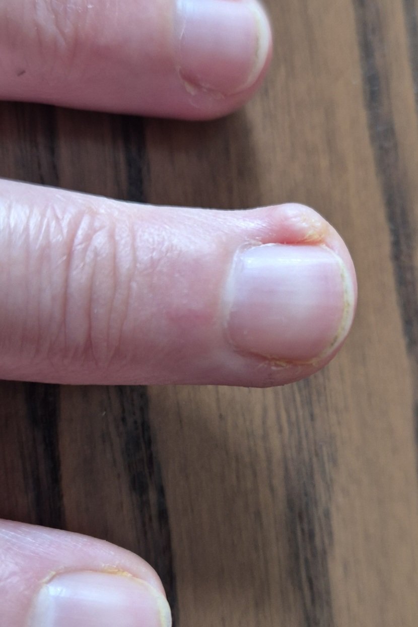 18 months after stopping skin picking