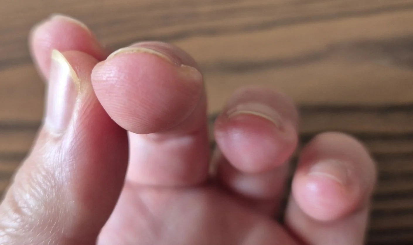 18 months after stopping skin picking