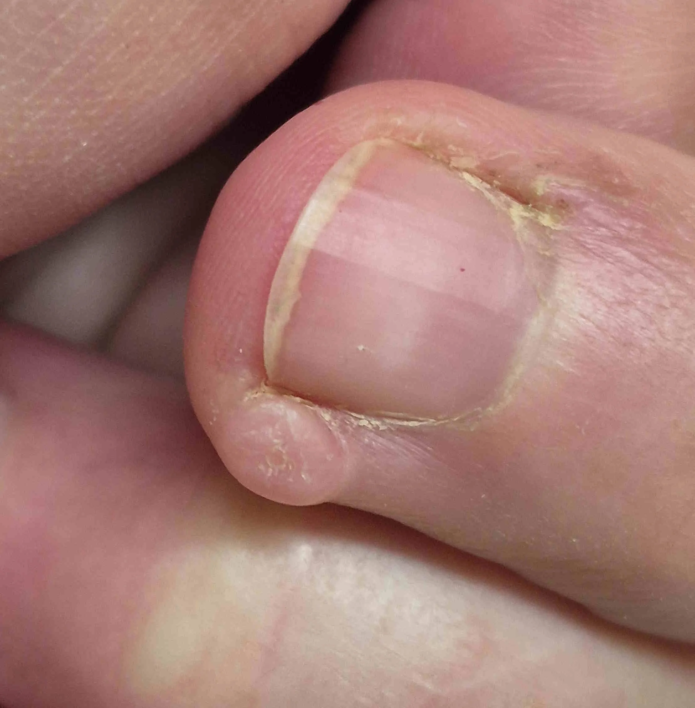 9 months after stopping skin picking