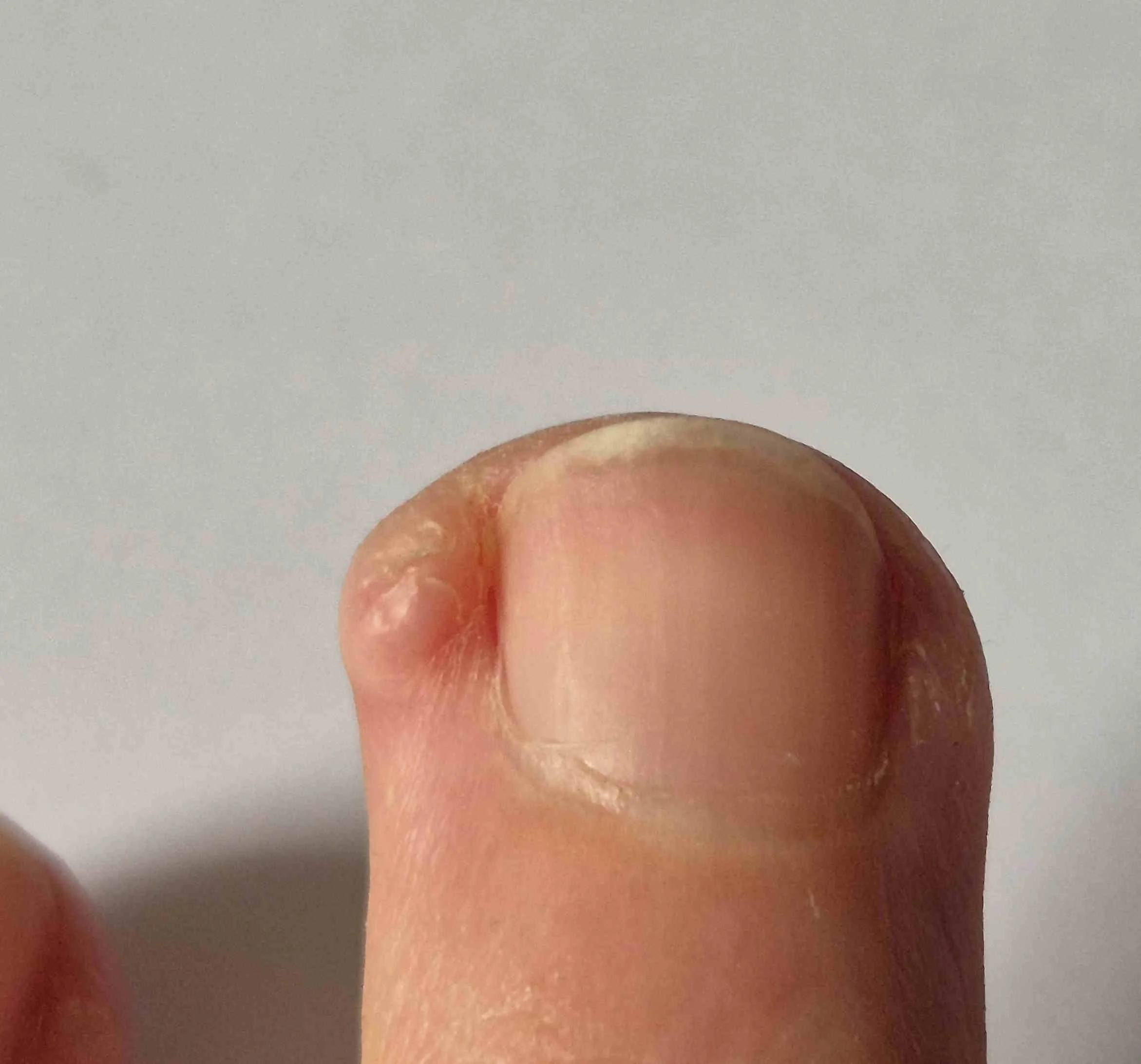 10 months after stopping skin picking