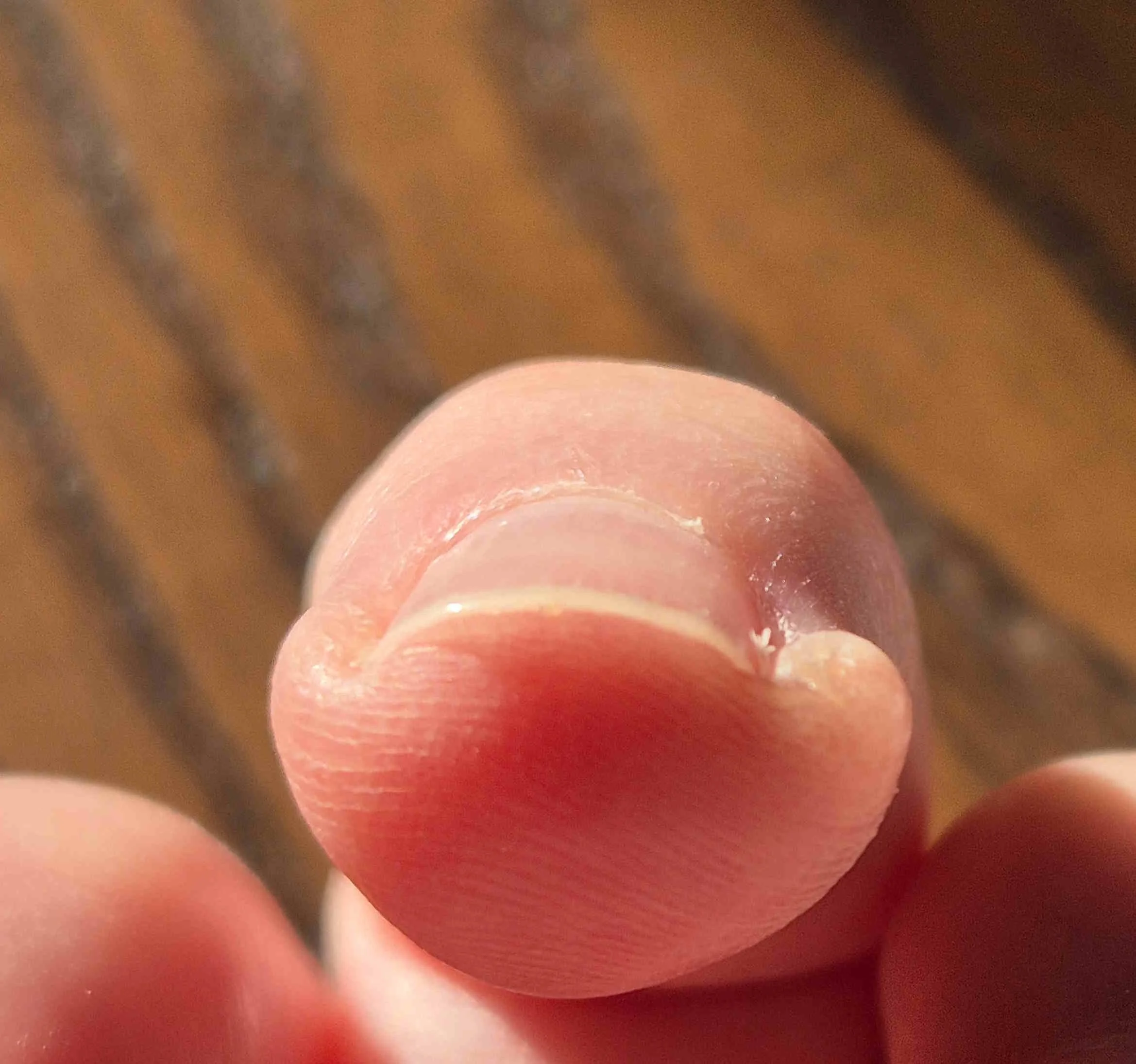 11 months after stopping skin picking