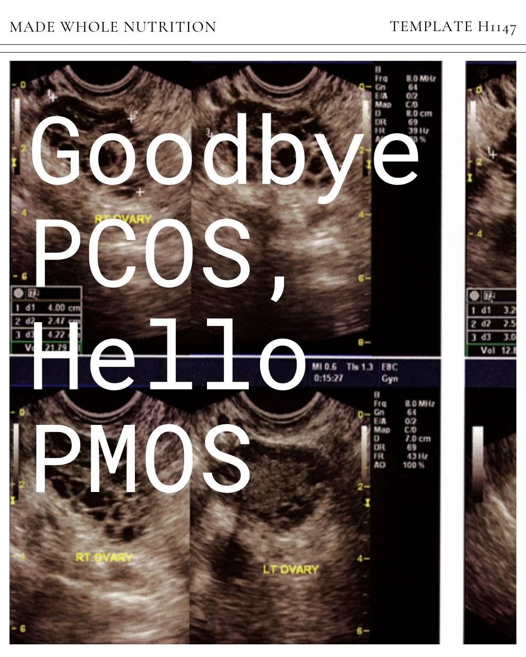 Have you seen this update? 
PCOS (polycystic ovarian syndrome) has been renamed PMOS (polyendocrine metabolic ovarian syndrome) to reflect the fact that it is more of a metabolic/hormonal issue than a reproductive one. The designation &ldquo;syndrome