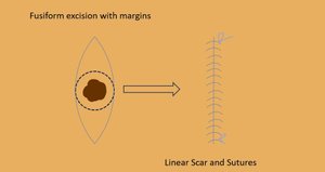 Comprehensive Guide to Skin Cancer Excisions and Aftercare According to ...