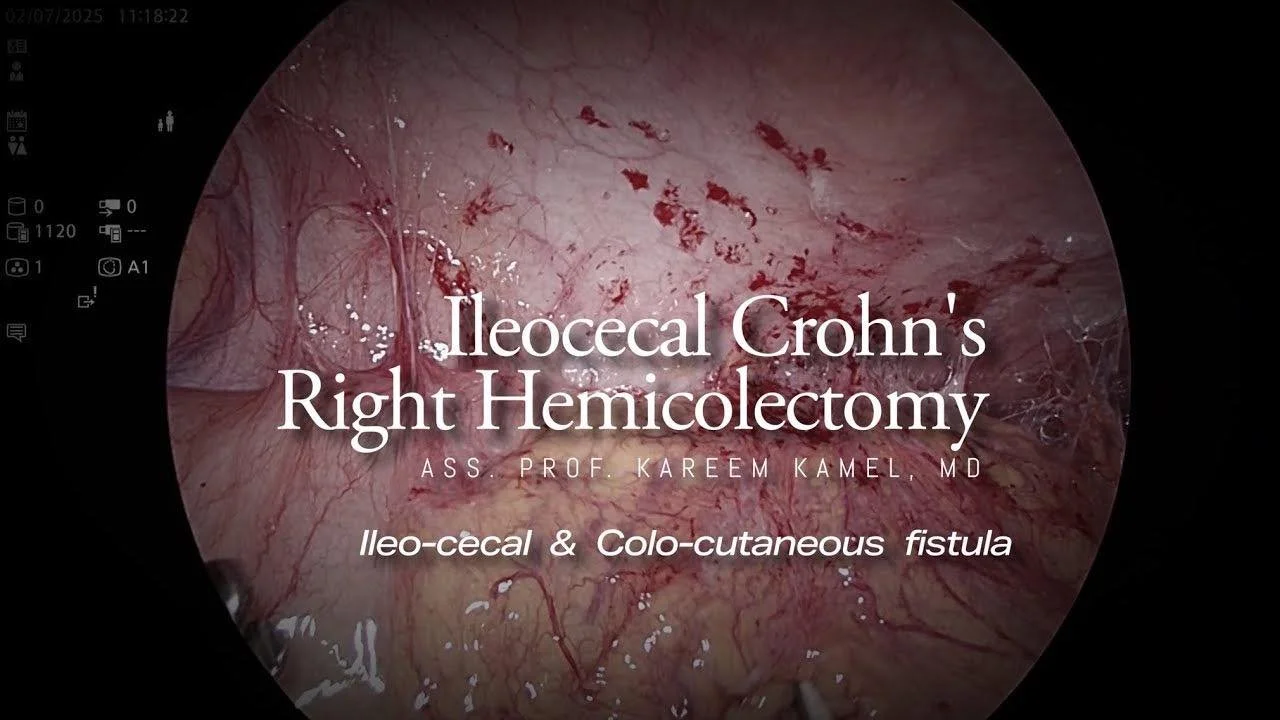 VIDEO IN THE COMMENT: Fistulizing ileocecal Crhon&rsquo;s with recurrent abscess and a colo-cutaneous fistula WITH VOICE. Highlighting a simple technique for the intra-corporeal anastomosis and a custom made simple endo-bag for specimen retrieval.
