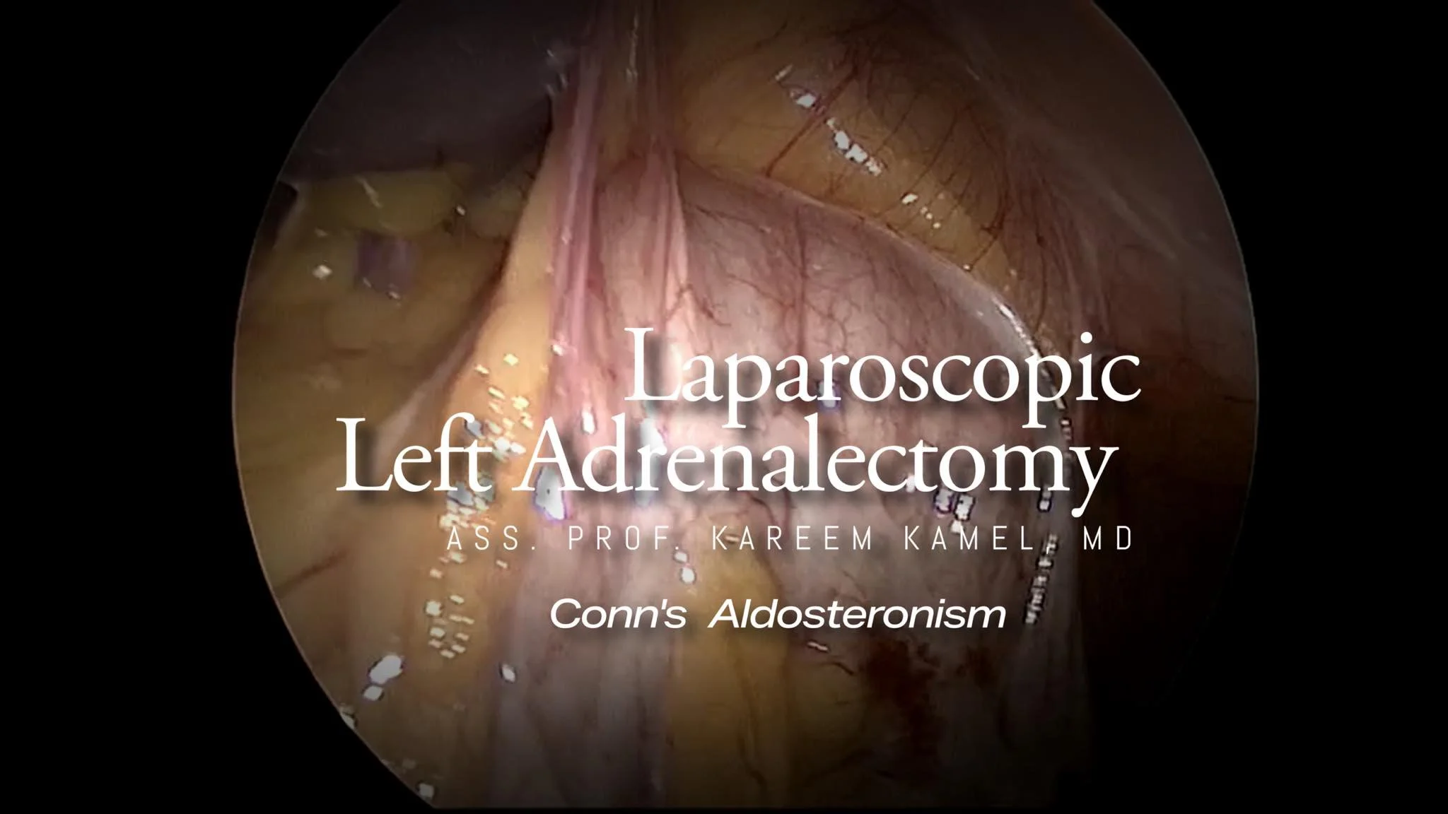 VIDEO IN THE COMMENT: Laparoscopic Left Adrenalectomy for Conn&rsquo;s tumor WITH VOICE. A Simple yet educational case for a step by step procedure. Highlighting a simple technique for a custom made simple endo-bag for specimen retrieval.