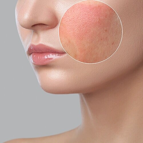 Medical DermatologyWell trained and experienced to treat, counsel, and provide education for both adult and pediatric skin conditions.