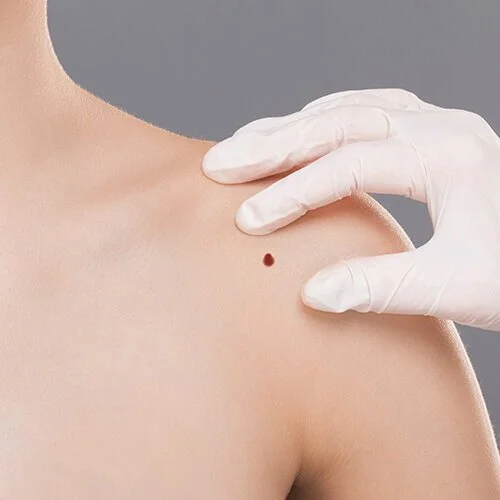 Skin Cancer ScreeningAdults with histories of extensive sun exposure, multiple skin burns, fair skin, and family histories of skin cancer should have their skin checked yearly. Any new, growing, changing or non-healing growths in any skin type shoul…