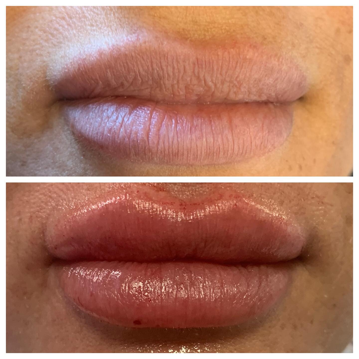 Lip transformation with emphasis on defining the Cupid's bow just in time for Valentine's Day ❤️