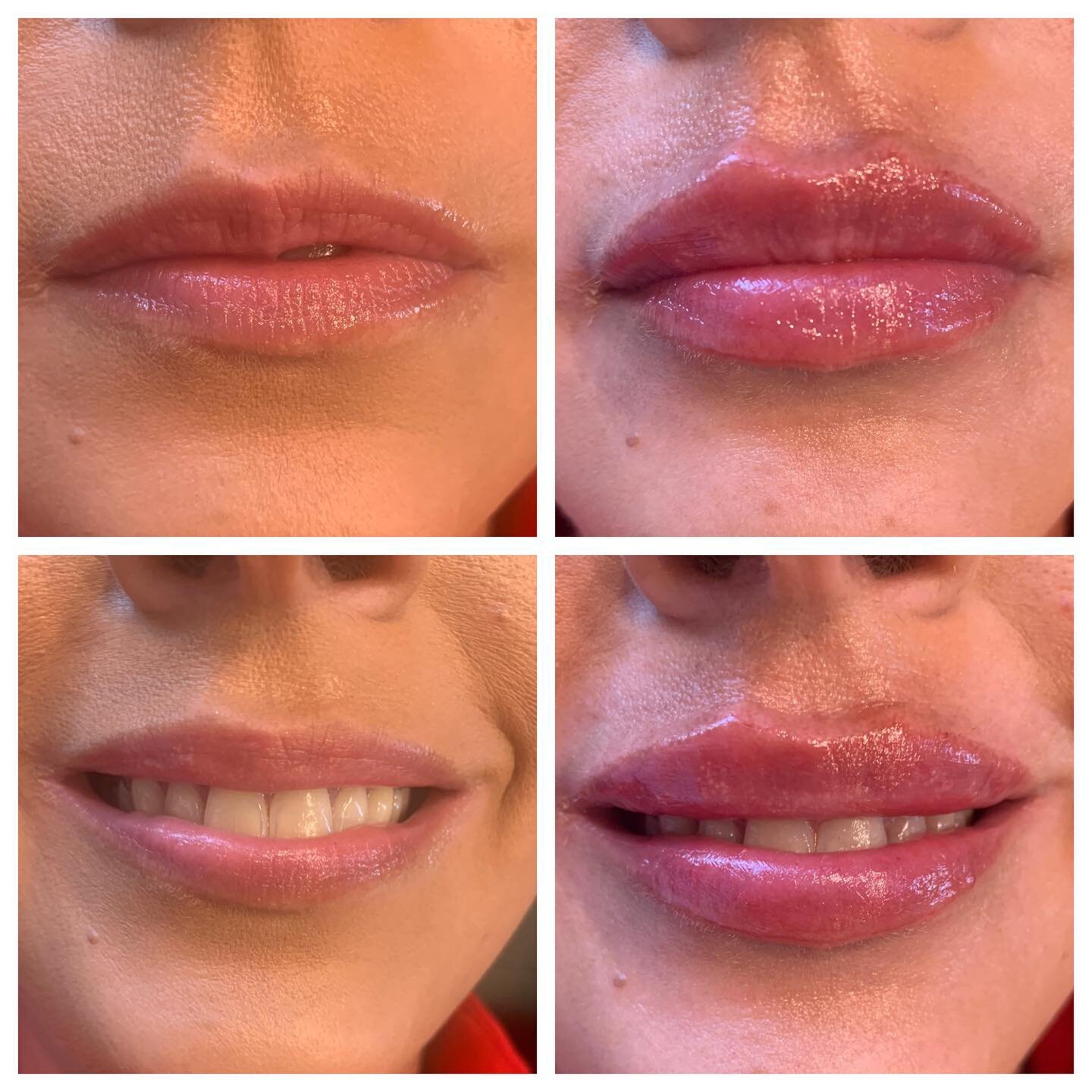 First time for lip fillers and her results are 🔥