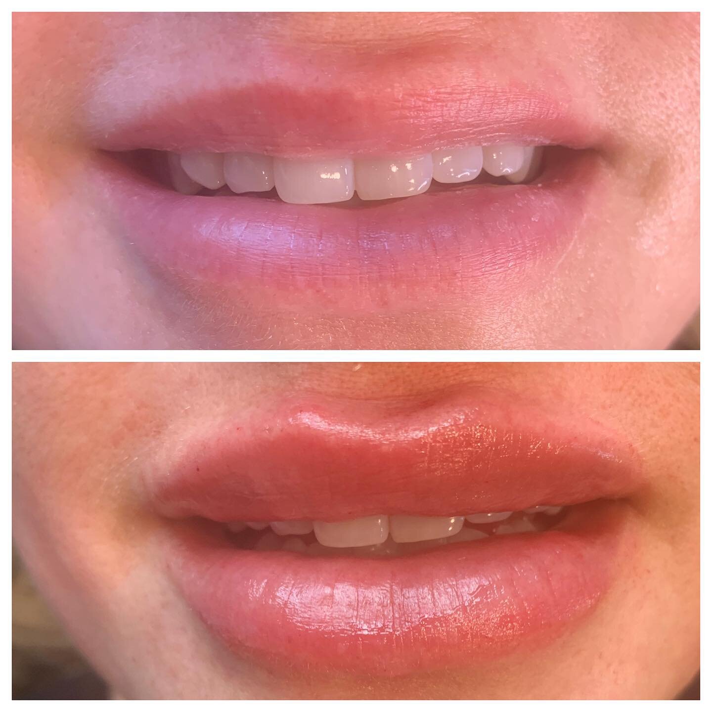 What a lip transformation for this client.
