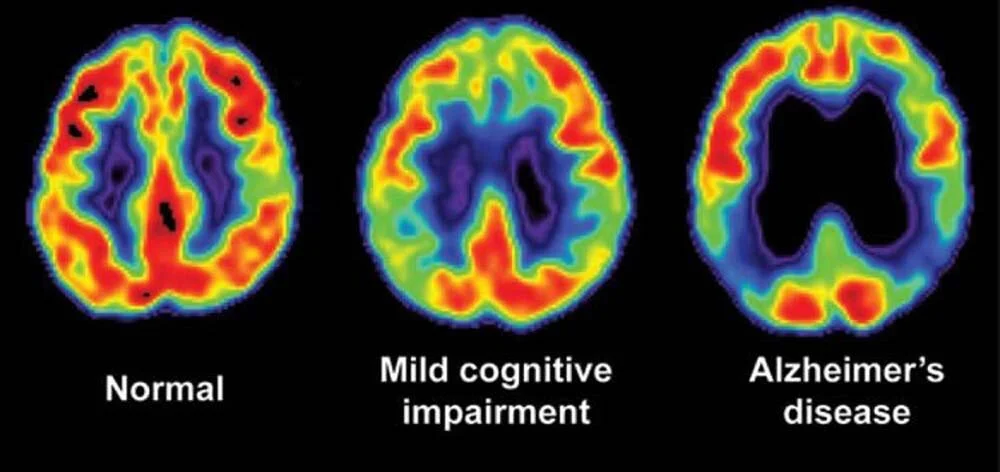 What if we could use tools to diagnose Alzheimer’s disease and dementia before the symptoms of cognitive and mental deterioration became clinically apparent?
The hope is to intervene with targeted therapies to treat the disease in its earliest stages