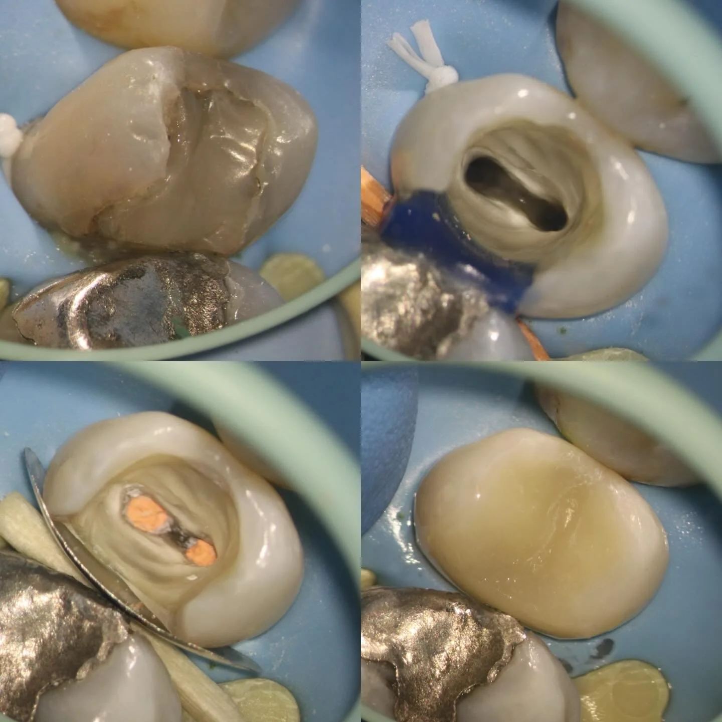 Single visit retreat and core.