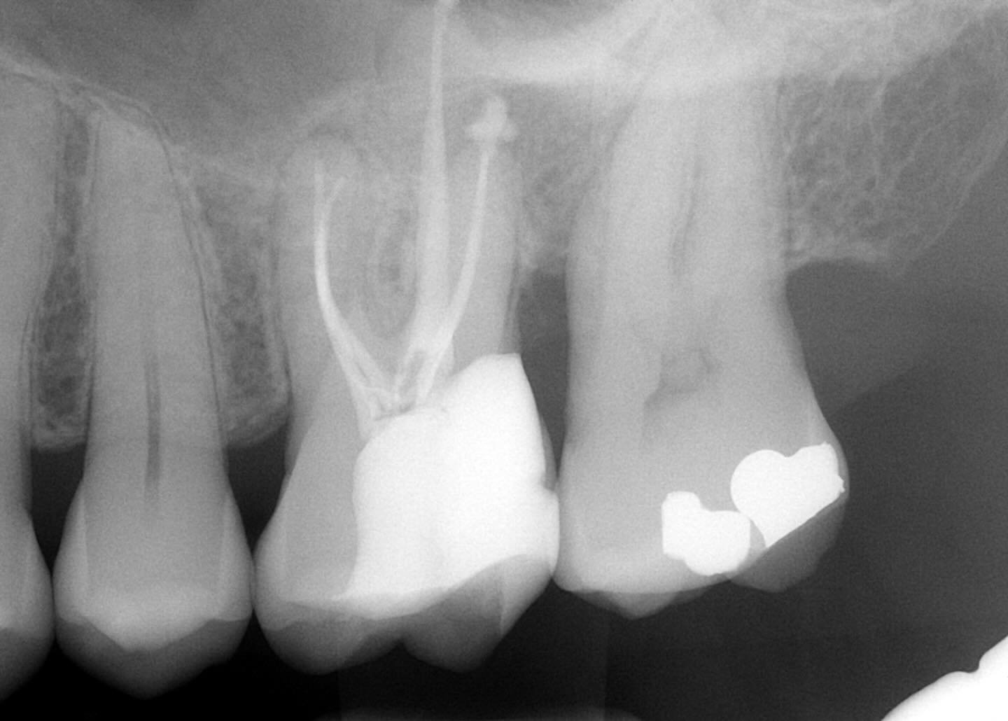 Deep caries, originally restored and tried to avoid rct but tooth became necrotic over time.