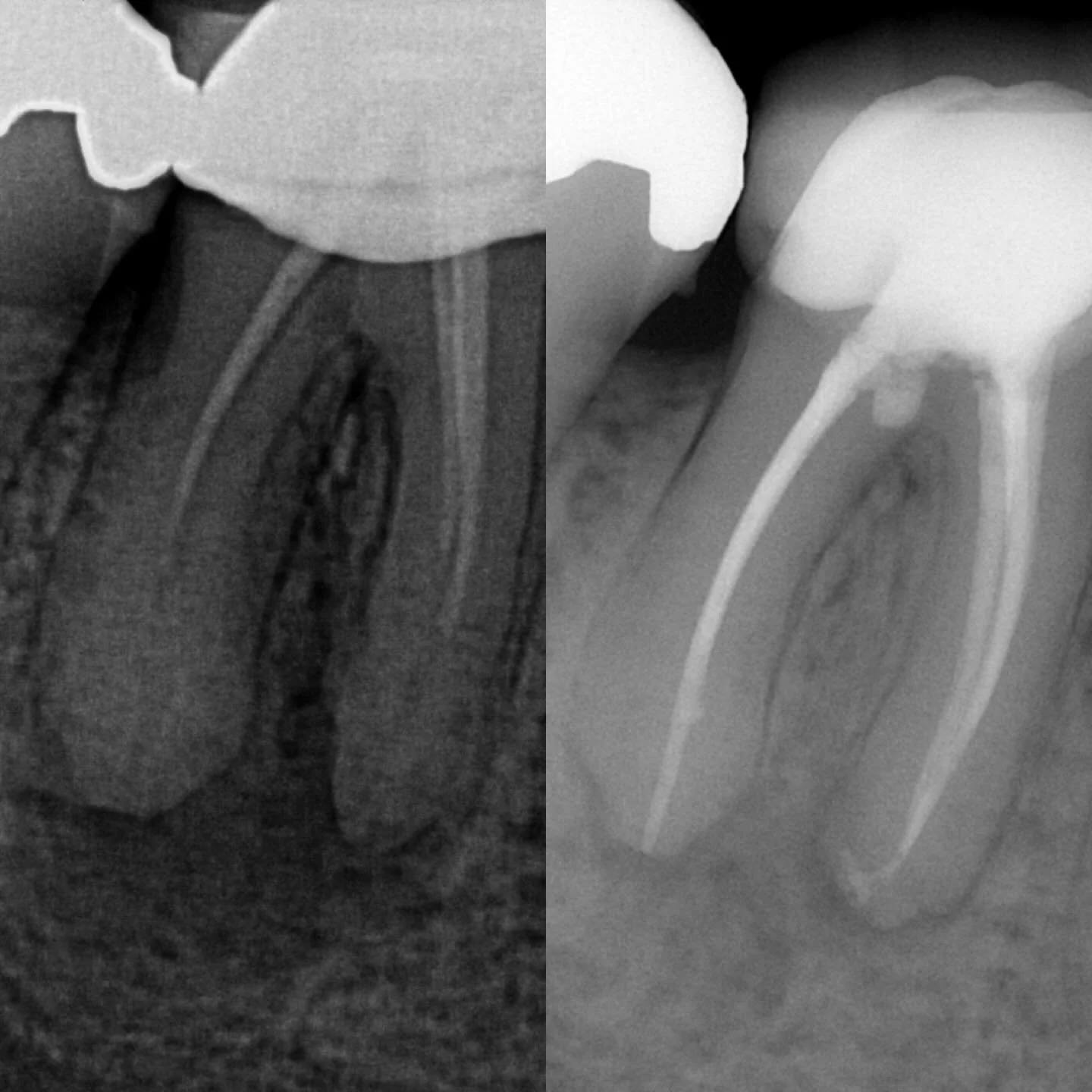 Retreat with small perforation repair in the furcation. 6/12 review to show healing prior to new crown