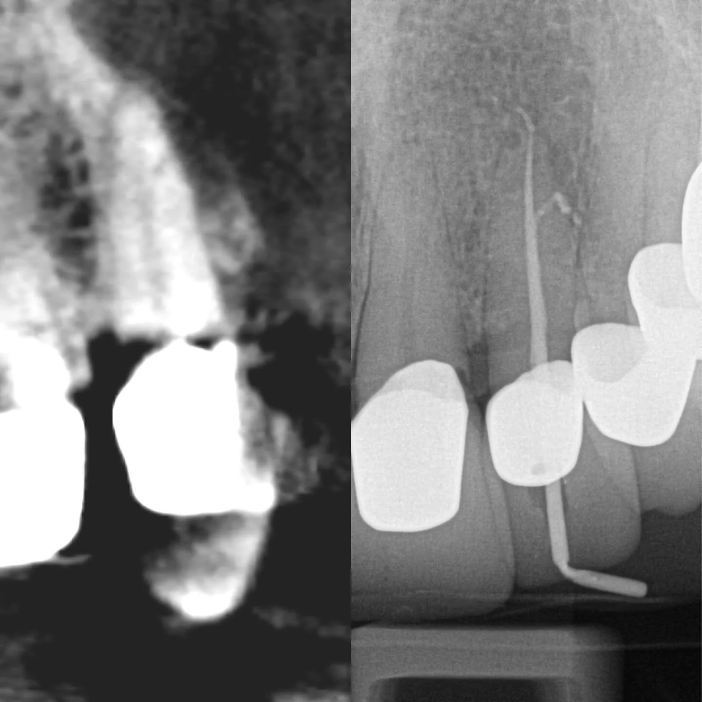 Lateral canal visible on the cbct. Completed through a recent crown.