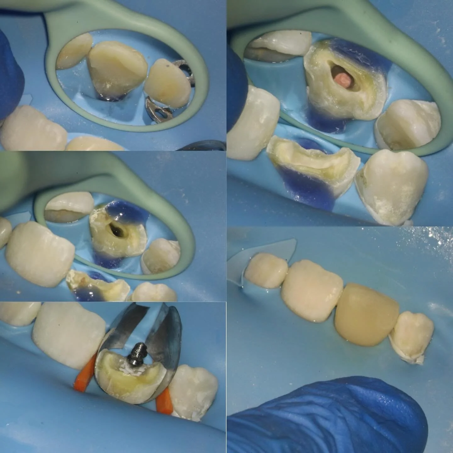 Trauma, open apex, tricky isolation to allow a good restorative core. Twin anterior matrix from @incidentalltd. 12 month review shows healing and advised definitive crown. Onefil putty plug apically