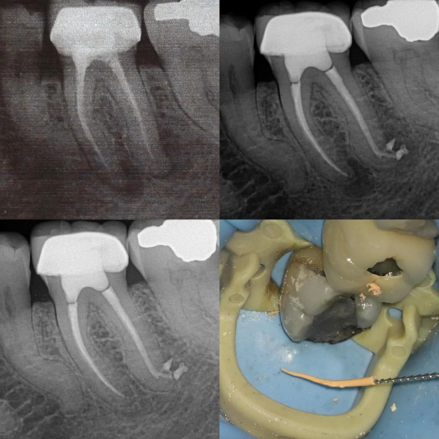 Retreat single visit. Hedstroem to remove the previous gp is the neatest way if possible. 12month review. Onefil bioceramic sealer