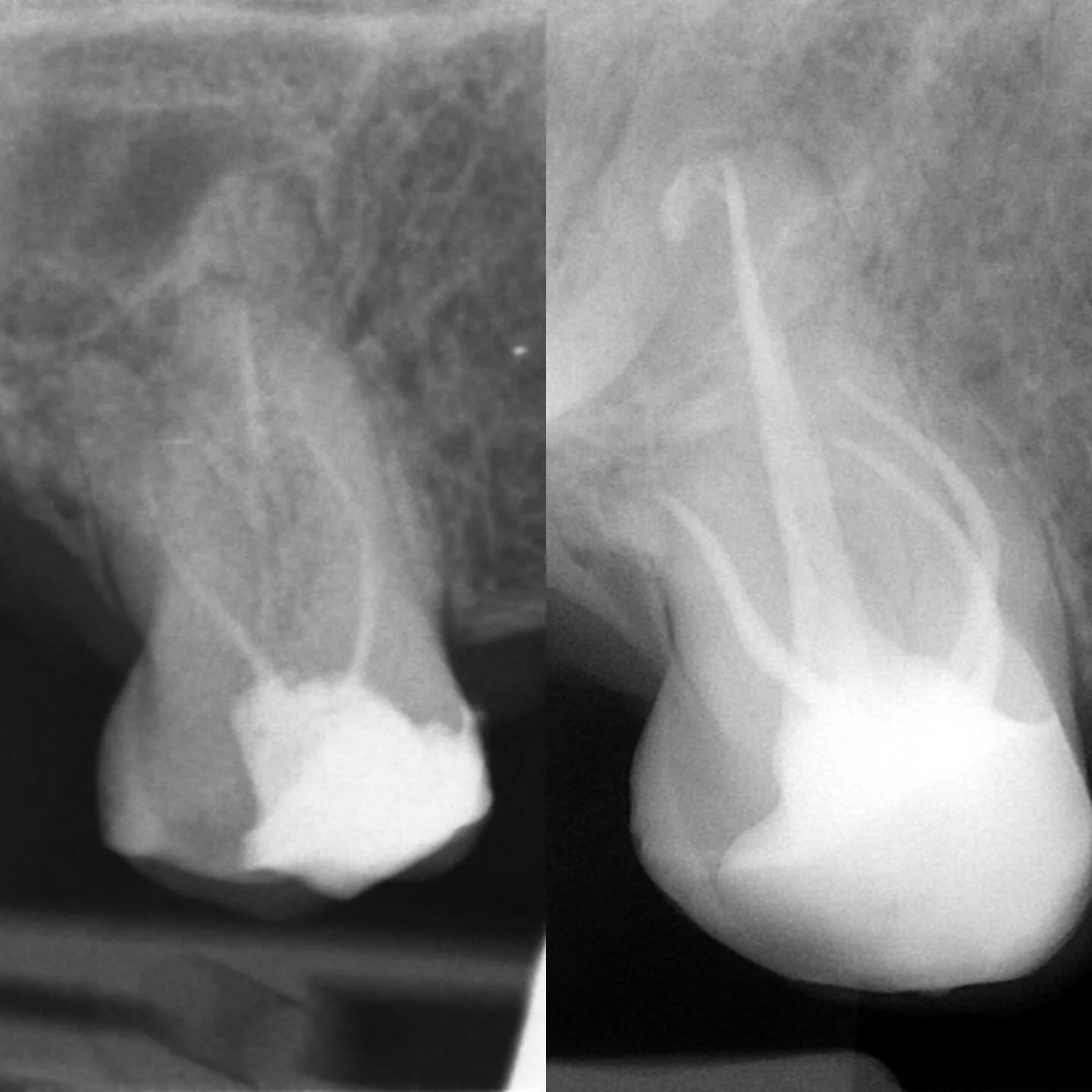 12 month follow up single visit retreat and core.