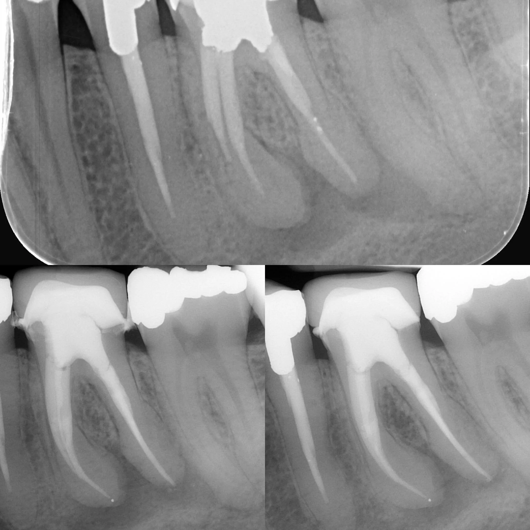 Retreat review at 6 months prior to new permanent crown