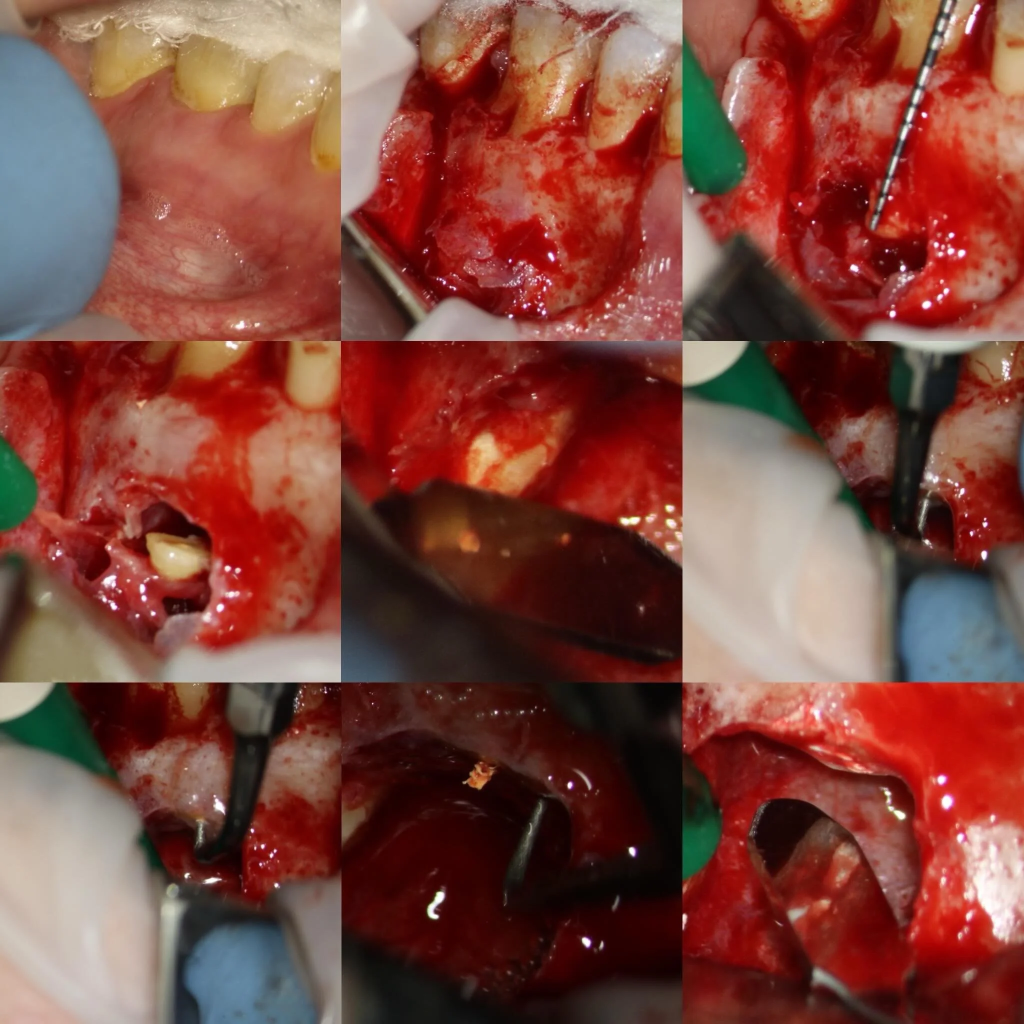 Upper first molar apical surgery healing at review.