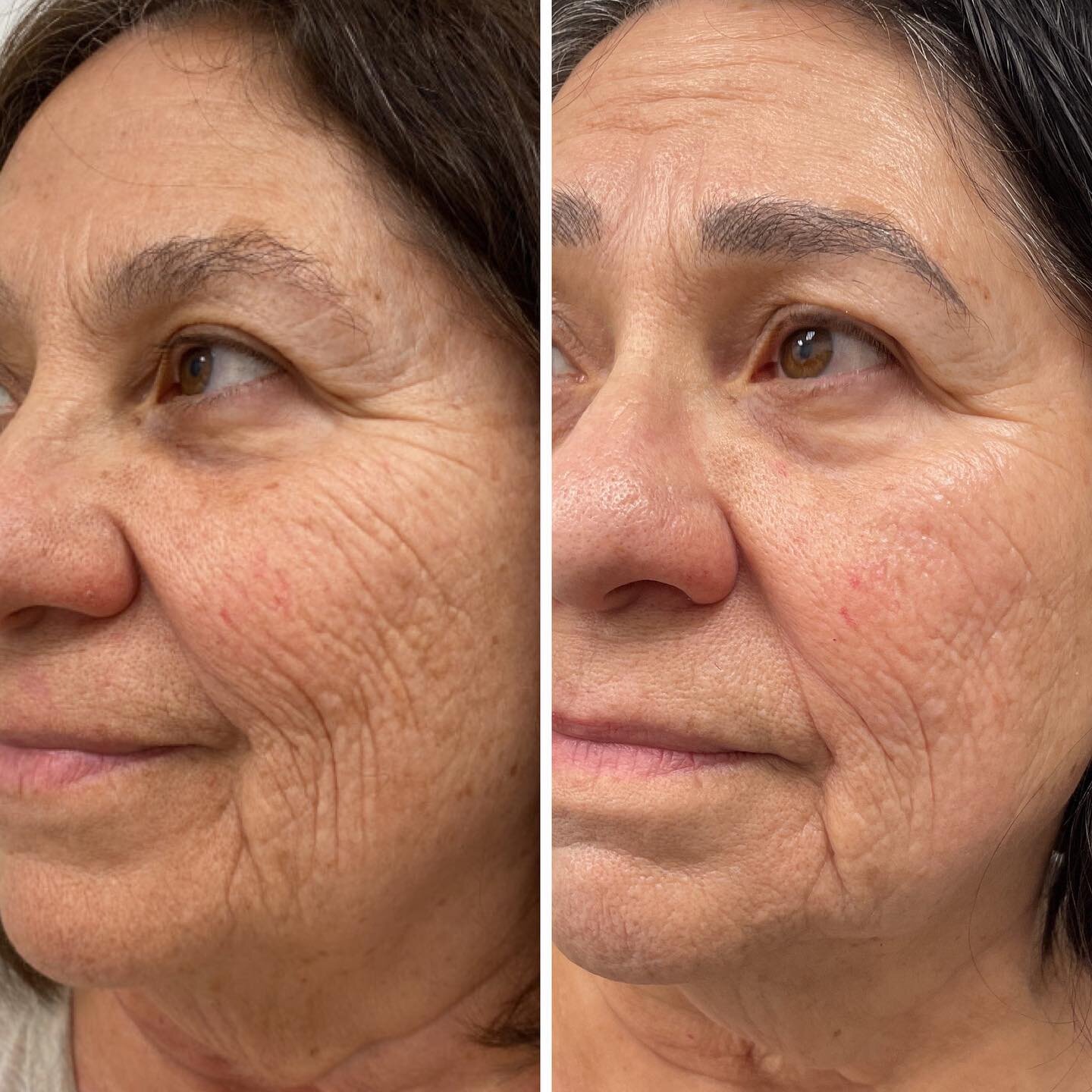Starting to see a difference!

Clients skin is now properly hydrated, smooth and skin tone has improved.

We will continue treatments to help minimize fine lines and wrinkles but client is happy overall.

I wish I had a magic 🪄 wand to speed up the 