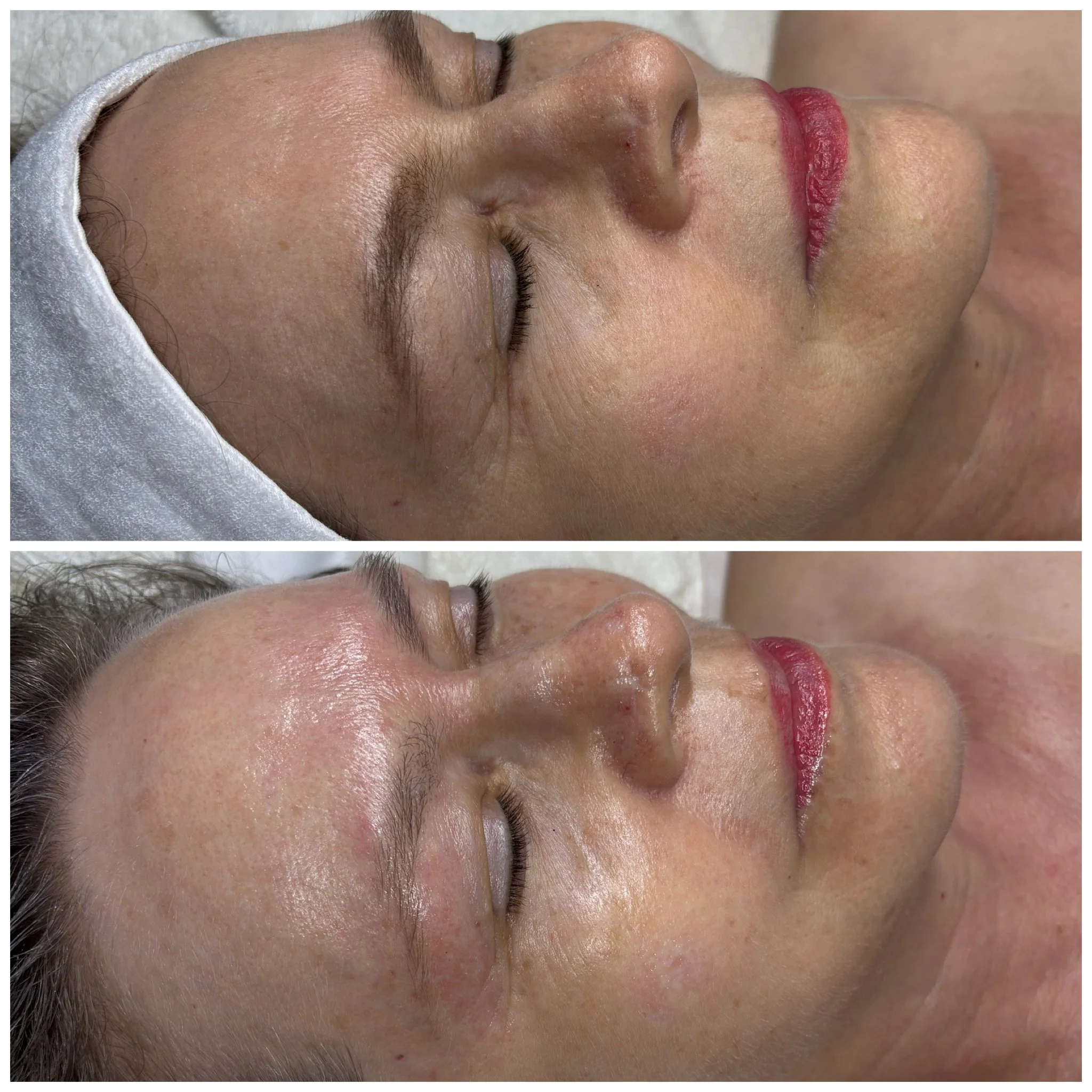 Anti aging facial.