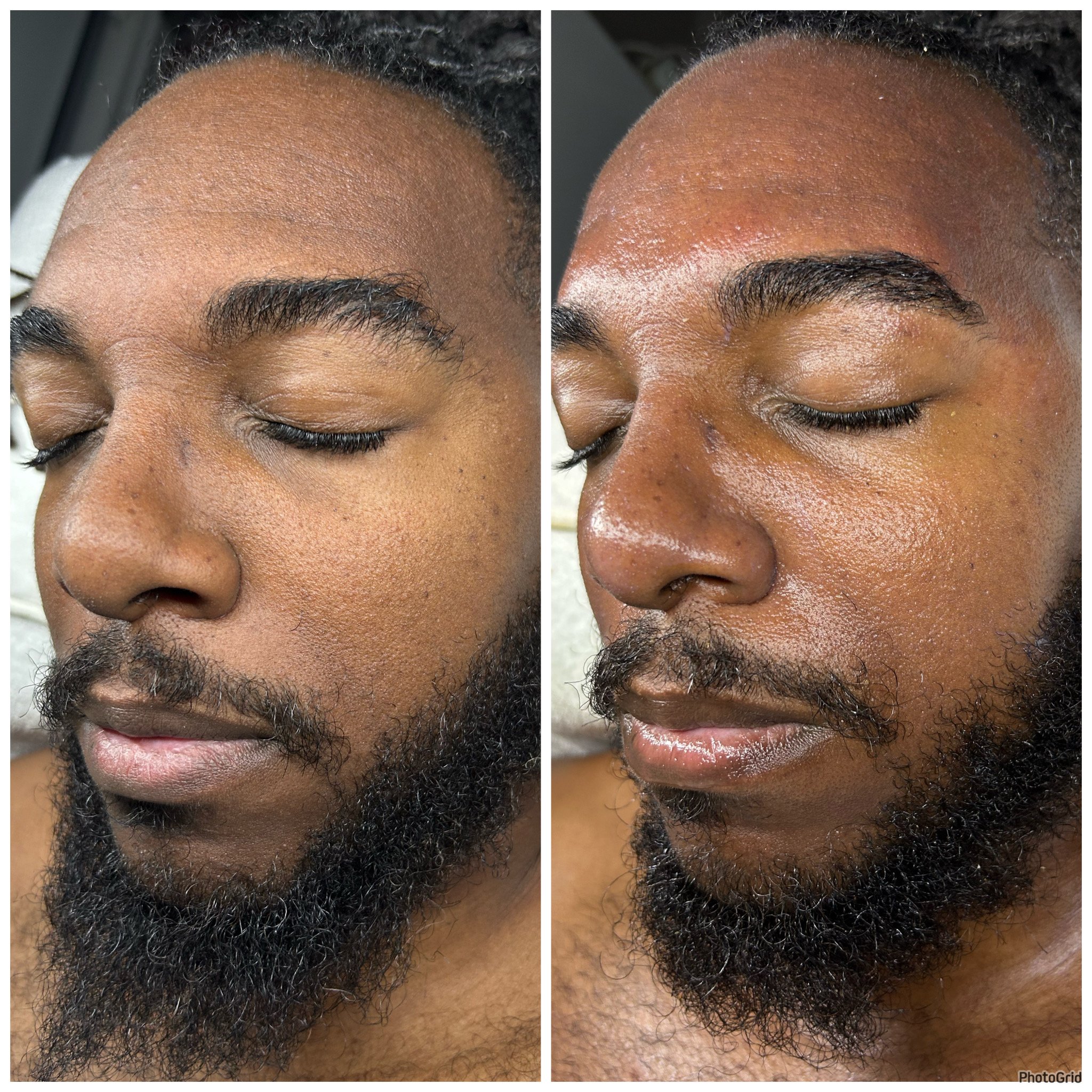 Brightening facial before and after. 