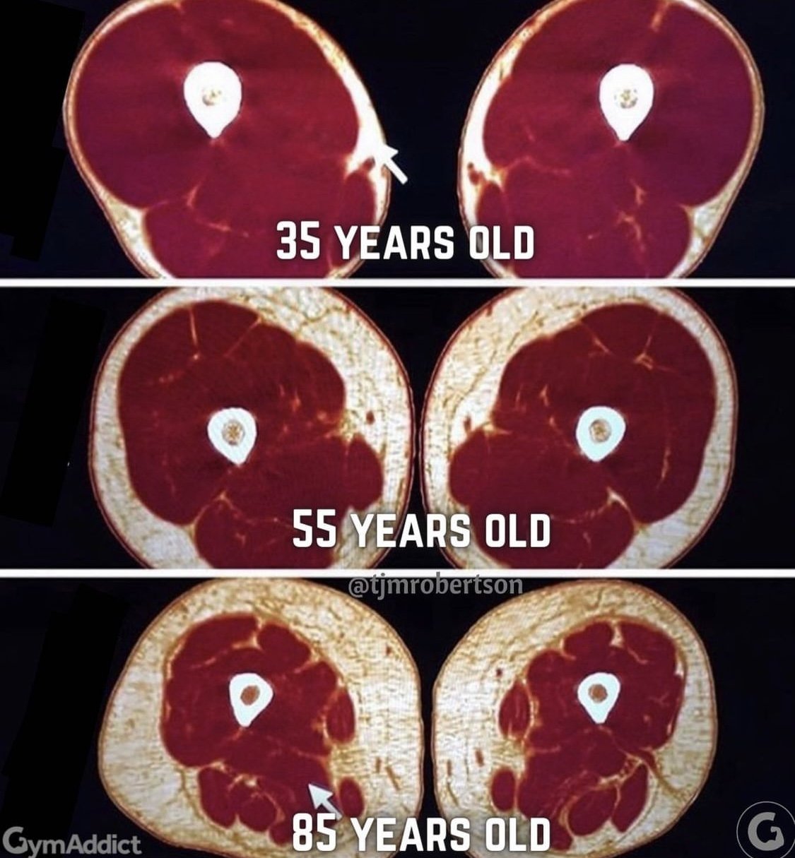 Muscle loss in menopause
