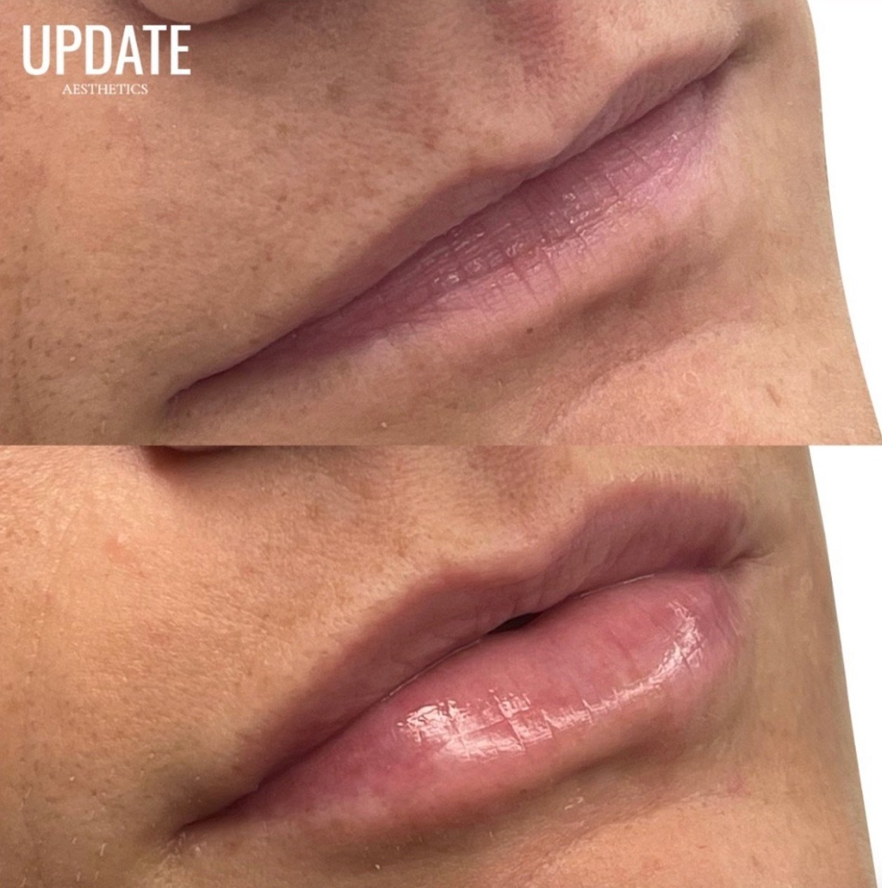 Nina&rsquo;s precision and expertise shine through in her approach to lip enhancements. ⁠
⁠
With a keen eye for detail, she understands that sometimes, a subtle boost is all it takes to elevate confidence. ⁠
⁠
Her natural approach ensures balance and