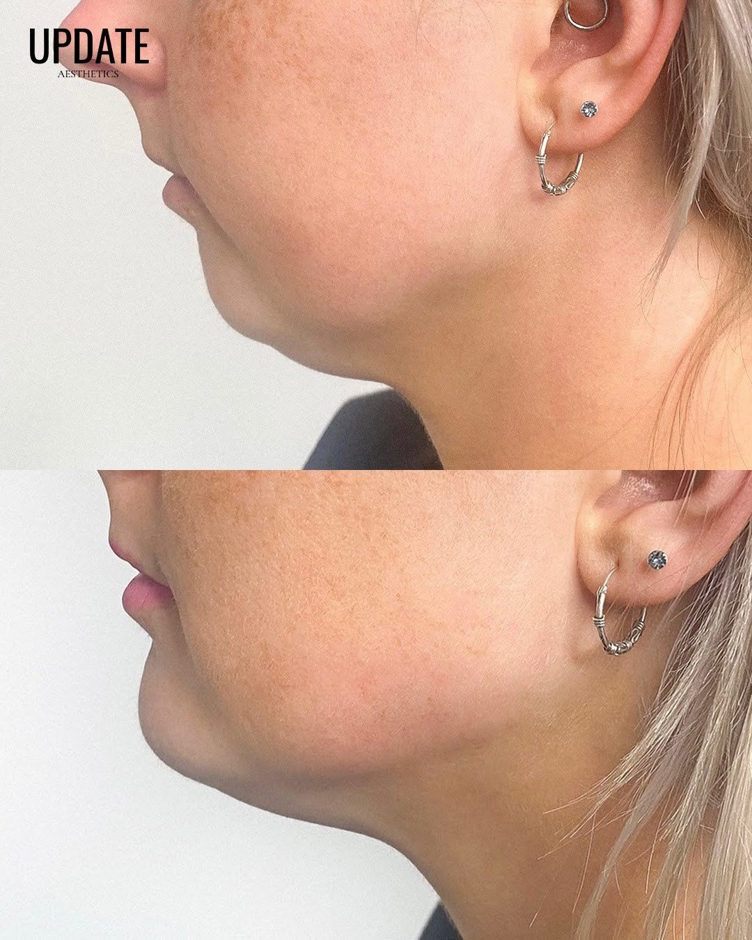 At Update Aesthetics, Nina's expertise in jaw augmentation using dermal fillers ensures that each enhancement is tailored to your unique facial features, resulting in a harmonious and natural-looking result. ⁠
⁠
Say hello to a defined and sculpted ja