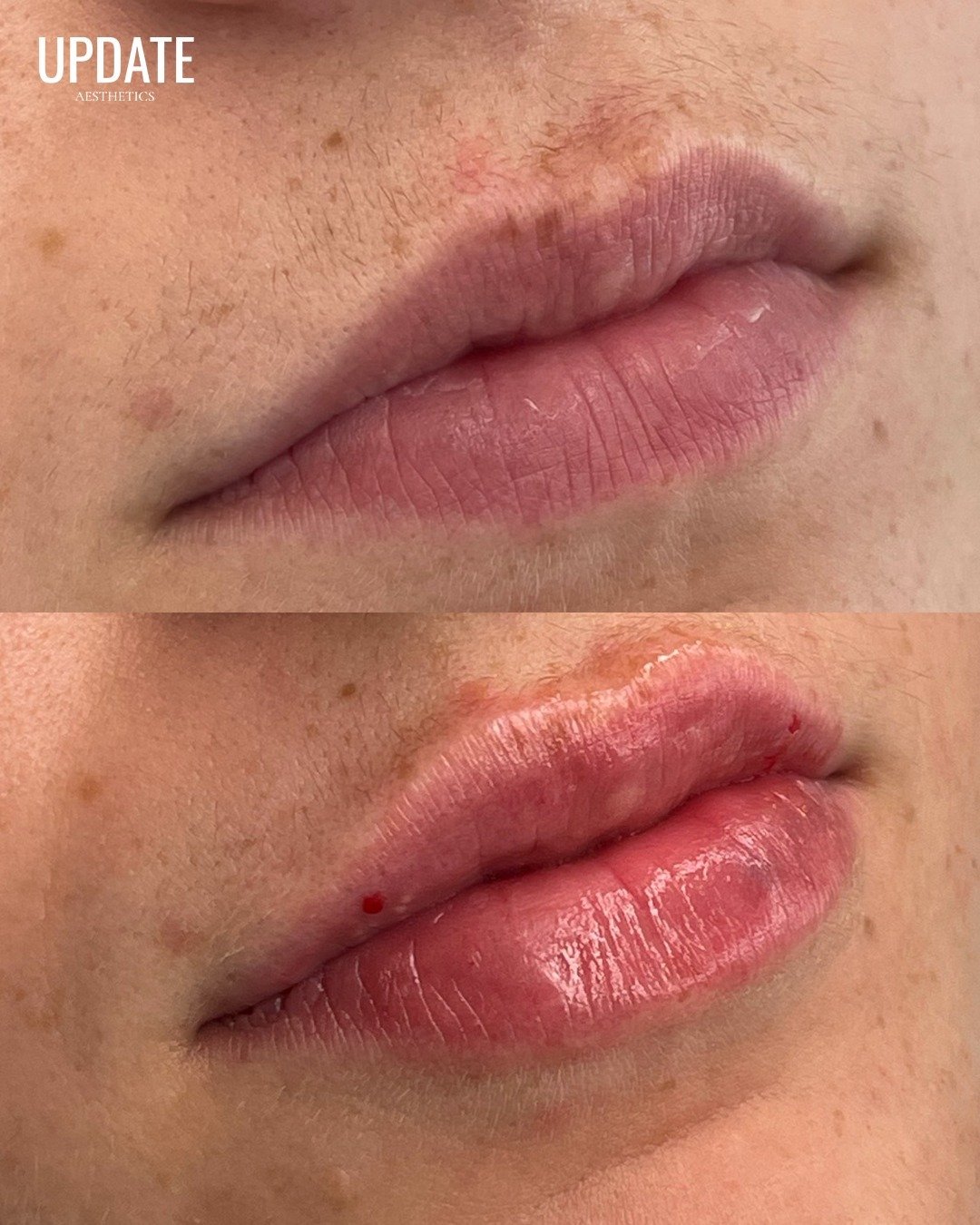 Sometimes, it only takes a small change to make a big difference, especially when it comes to lip filler. 💋 ⁠
⁠
With just a subtle enhancement, Nina can create fuller, more balanced lips that beautifully complement your natural features. ⁠
⁠
Book yo