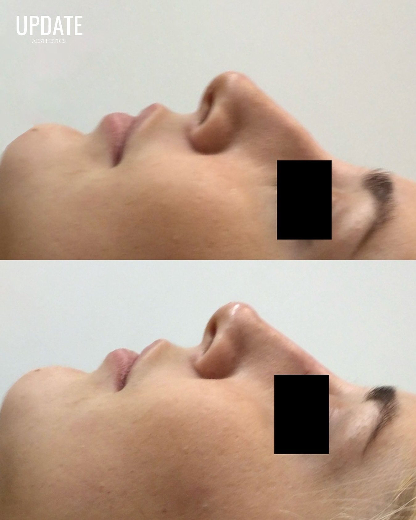 Thinking about enhancing your profile without the downtime of surgery? A non-surgical rhinoplasty could be the perfect solution.

With just a few subtle tweaks, Nina can create a beautifully balanced nose that enhances your natural features.&nbsp;

T