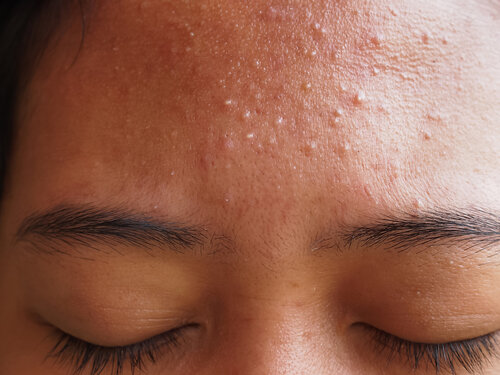 Best Acne Treatment & Skincare Product Australia | Qr8 MediSkin — QR8