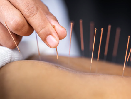 Acupuncture Edmonton.png
