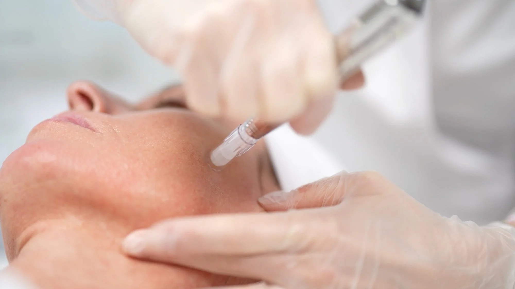 Microneedling + LAB91 = Deine individuelle Hauterneuerung