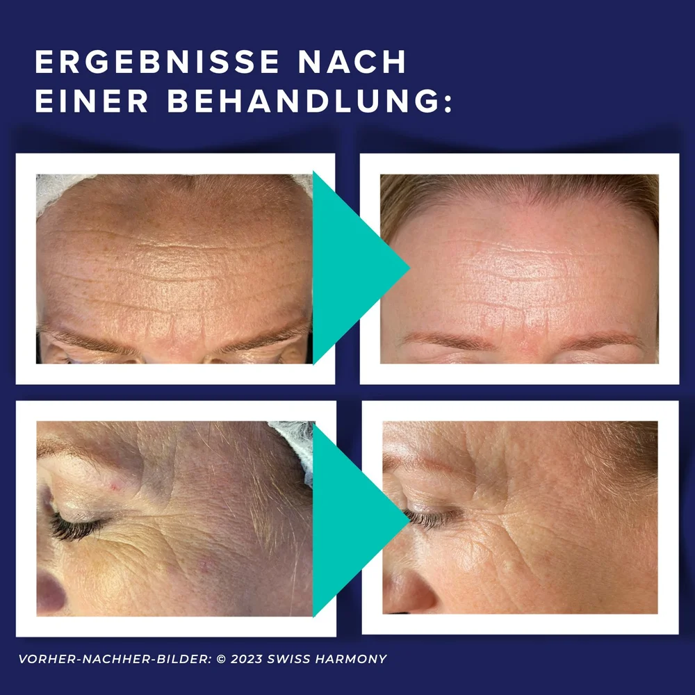 RFMicroneedling mit Vakuum Das Geheimnis ewiger Jugend — Swiss Harmony Der Spezialist für