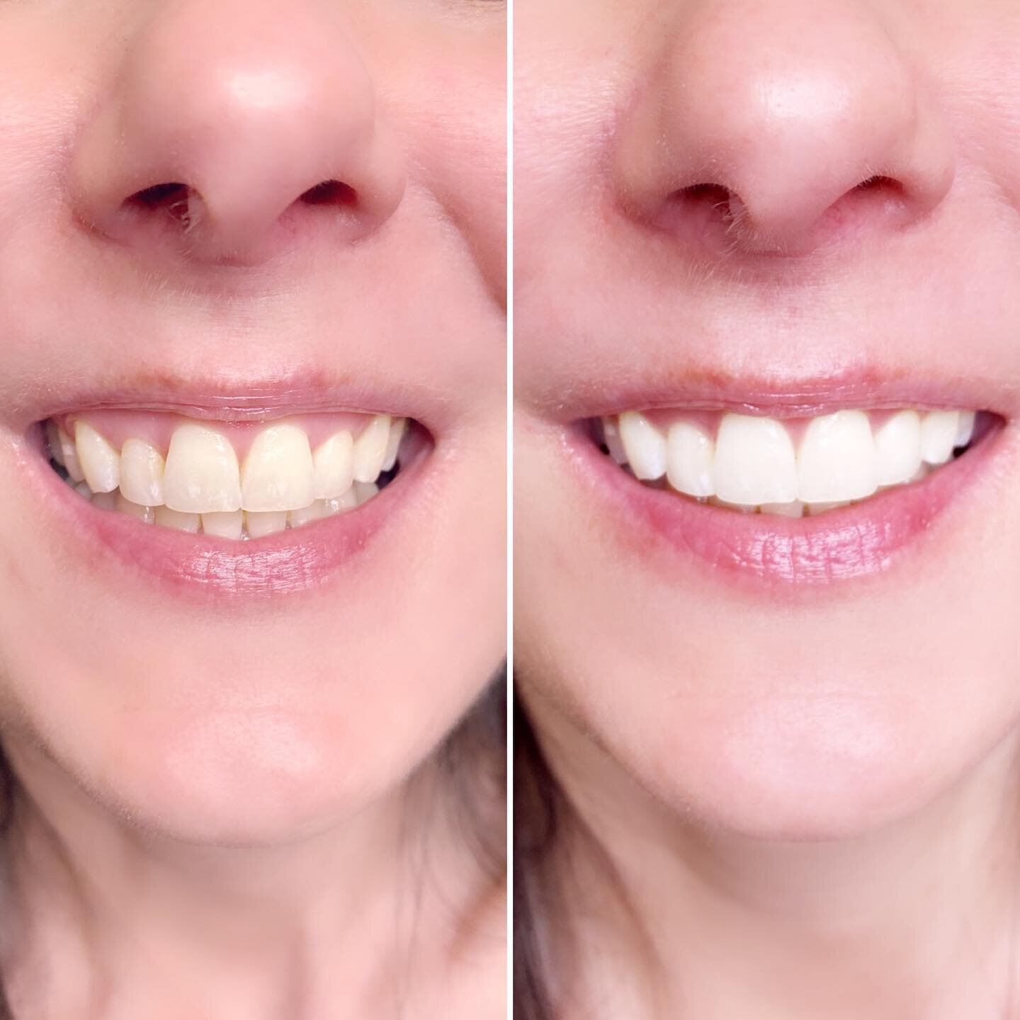 Shine on, with your pearly whites!  Teeth whitening with NO SENSITIVITY or ZINGERS?! You bet!  This client jumped 8 shades in just ONE session at REVEAL Beauty Spa.  DM us to schedule the start of your  brightened smile 😁

#teethwhitening #smile #br